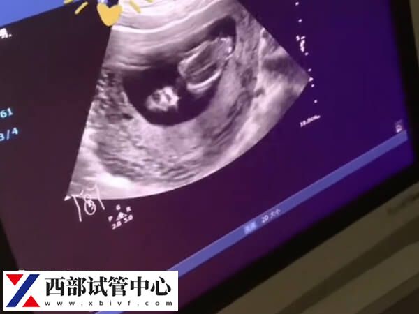 能不能選擇彩超來(lái)檢查卵泡是否破裂