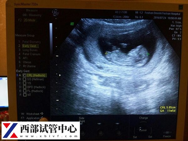 試管嬰兒進(jìn)周期前要做b超檢查