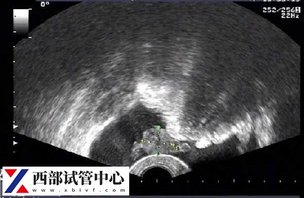 囊胚移植一超沒有卵黃囊二超可能會有