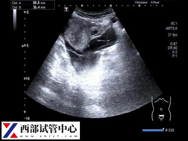 卵黃囊通常在懷孕的第5到第10周之間可見